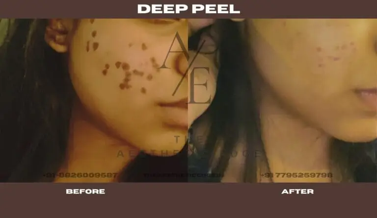 Deep chemical peel before and after