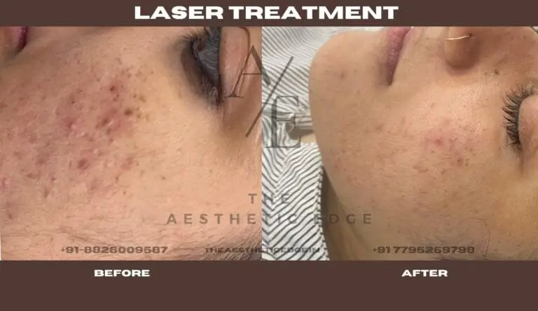 Q-switch laser pigmentation removal before and after